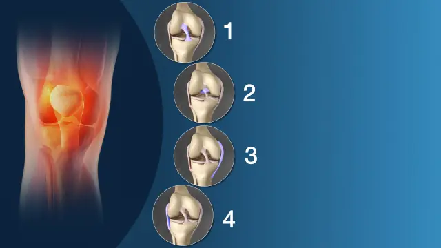 Lesão de ligamento cruzado: o que é e quanto tempo leva de fato